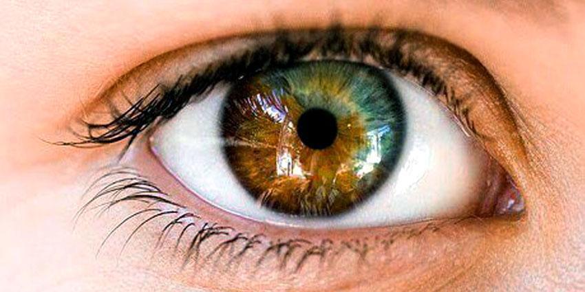 Секторальная гетерохромия глаз у людей