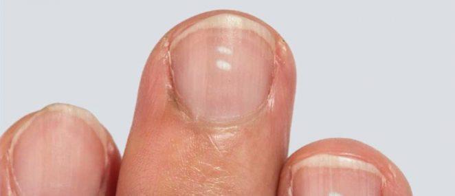 Белые пятна на ногтях действительно признак дефицита кальция?